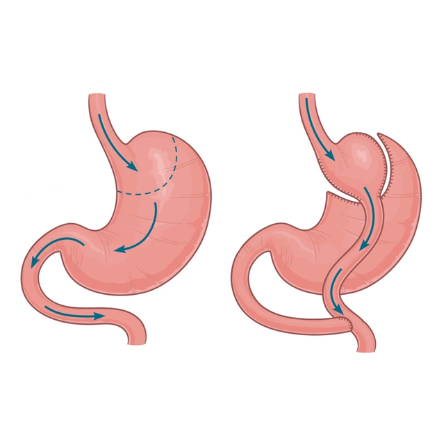 gastric-bypass – Op. Dr. Serkan TÜGEN