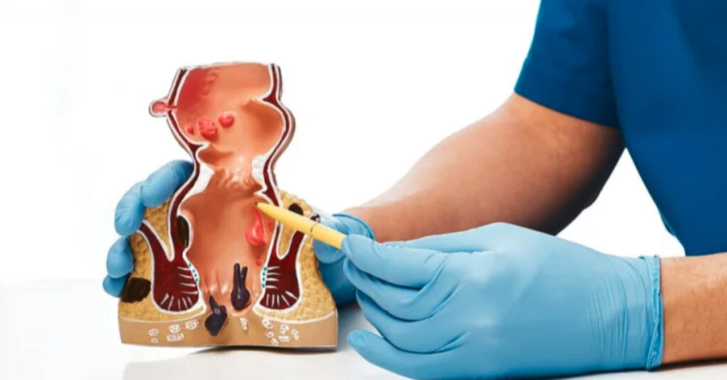 anal-fistul-1024x536