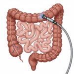 kolonoskopi-nedir