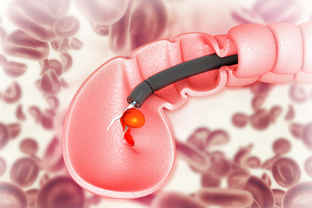 kolonoskopi-nasil-yapilir