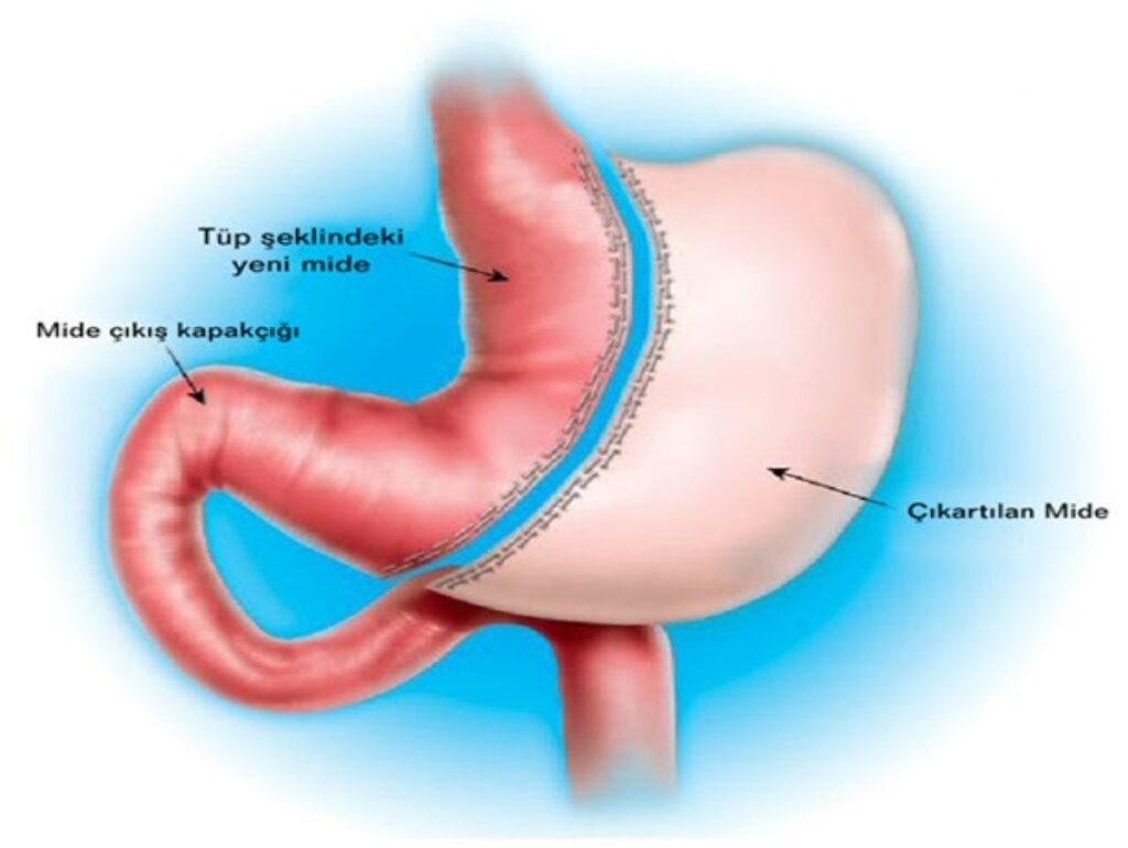 obezite-ameliyati-fiyatlari-2026