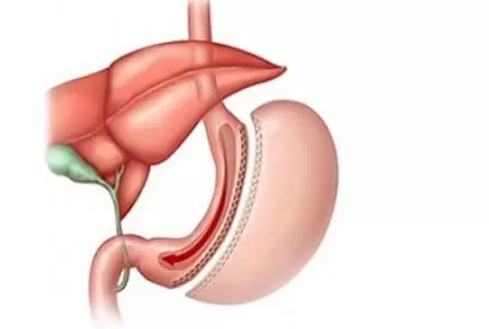 obezite-ameliyati-fiyatları