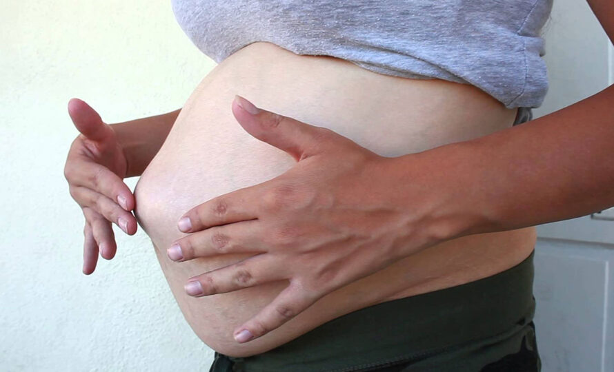 Göbek Fıtığı Nedir? Tedavisi Nasıl Yapılır? 16 gobek fitigi