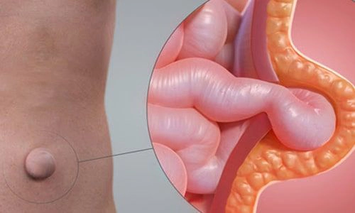 Göbek Fıtığı Nedir? Tedavisi Nasıl Yapılır? 3 gobek-fitigi