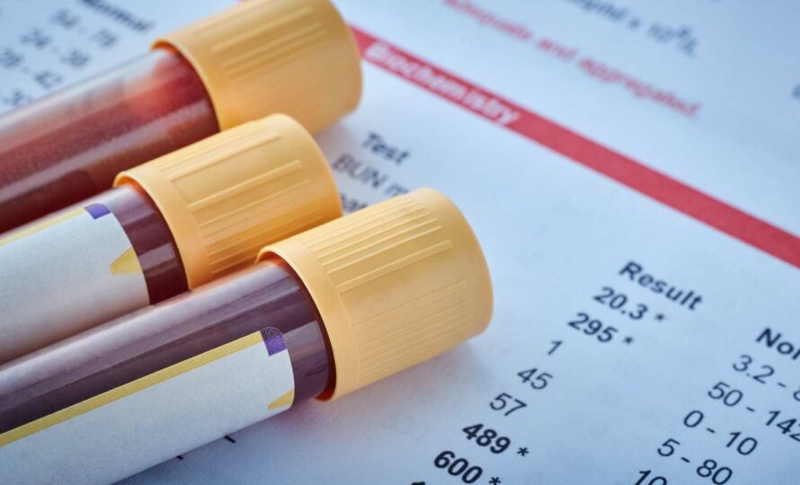Tüp Mide Ameliyatı Öncesi Hangi Testler Yapılır? 15 oncesi testler